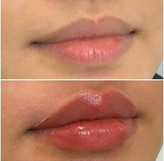 حجم دهنده لب گابرینی