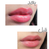 حجم دهنده لب آمپولی