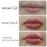 حجم دهنده لب آمپولی